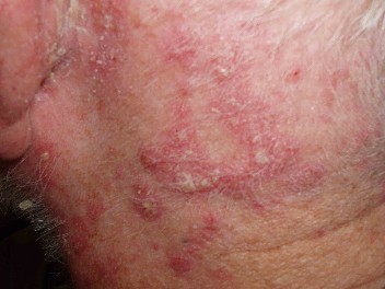 Contact dermatitis - Wikipedia